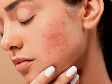 Ivermectin Cream | Shaanxi BLOOM Tech Co., Ltd Ivermectin Cream | Shaanxi BLOOM Tech Co., Ltd