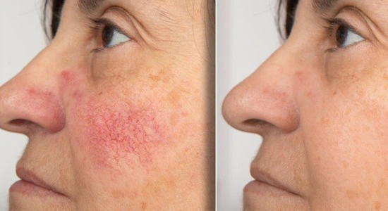 Ivermectin Stromectol Tablet | Shaanxi BLOOM Tech Co., Ltd Ivermectin Stromectol Tablet | Shaanxi BLOOM Tech Co., Ltd